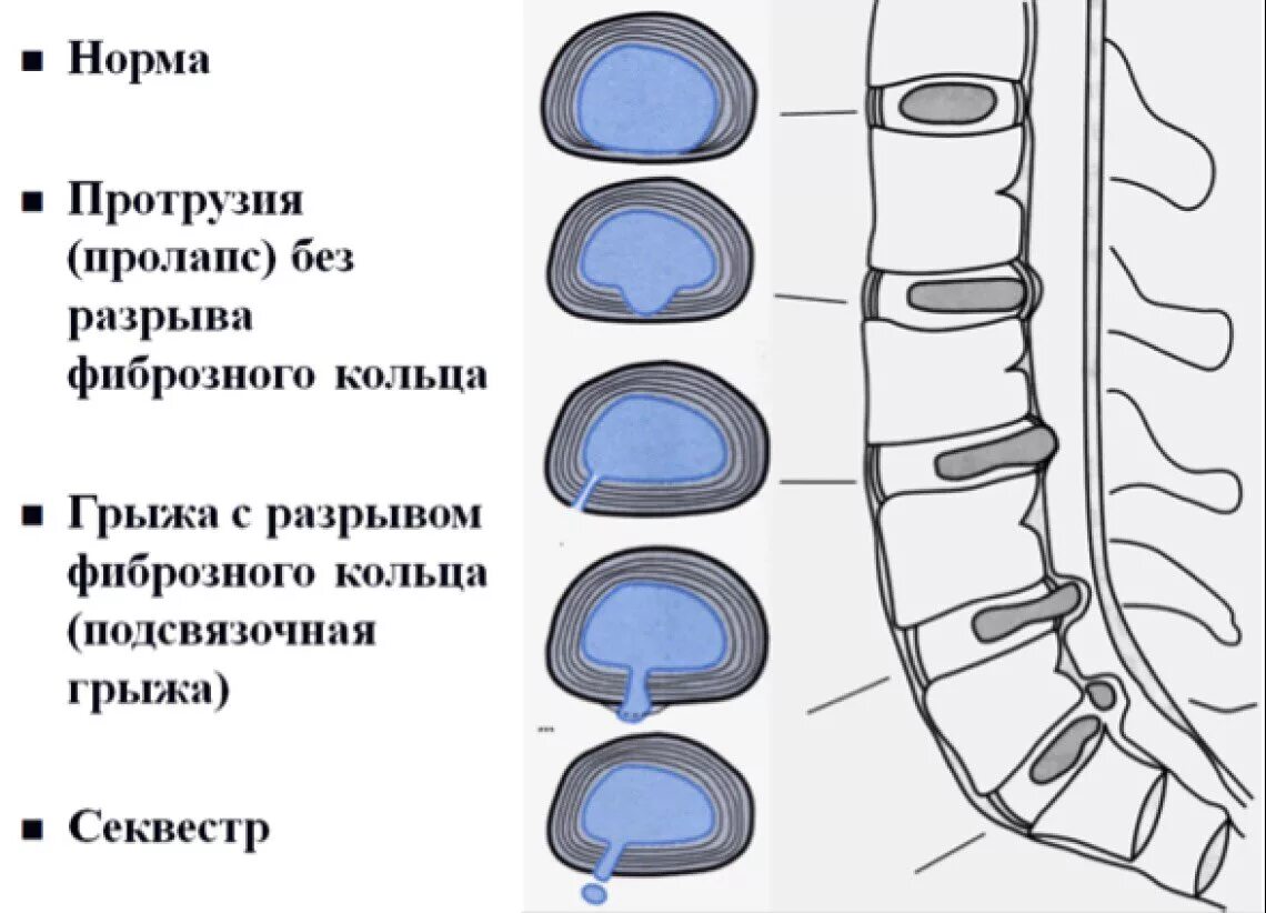 Протрузия дисков позвоночника что это такое. Экструзия диска l5-s1 9мм. Экструзии межпозвонковых дисков. Протрузии экструзии межпозвонковых дисков.