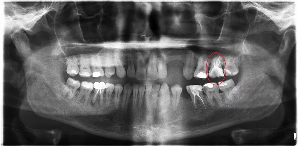 Снимок зубов видное. Ортопантомограмма кариес. Хронический гангренозный пульпит рентгенограмма.