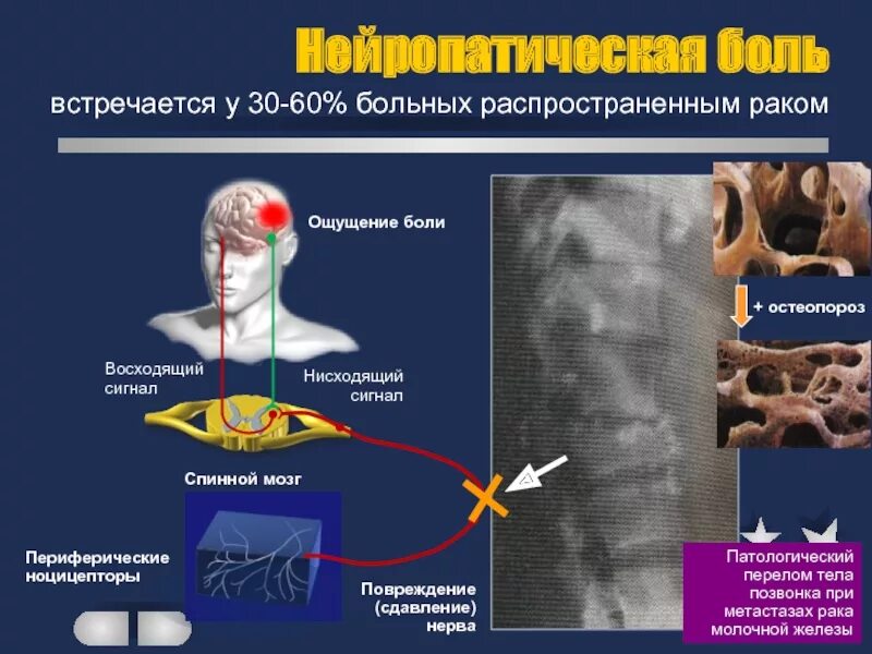 Хронические сильнейшие боли. Фармакотерапия нейропатической боли. Симптомы нейропатической боли. Хроническая нейропатическая боль. Схема нейропатической боли.