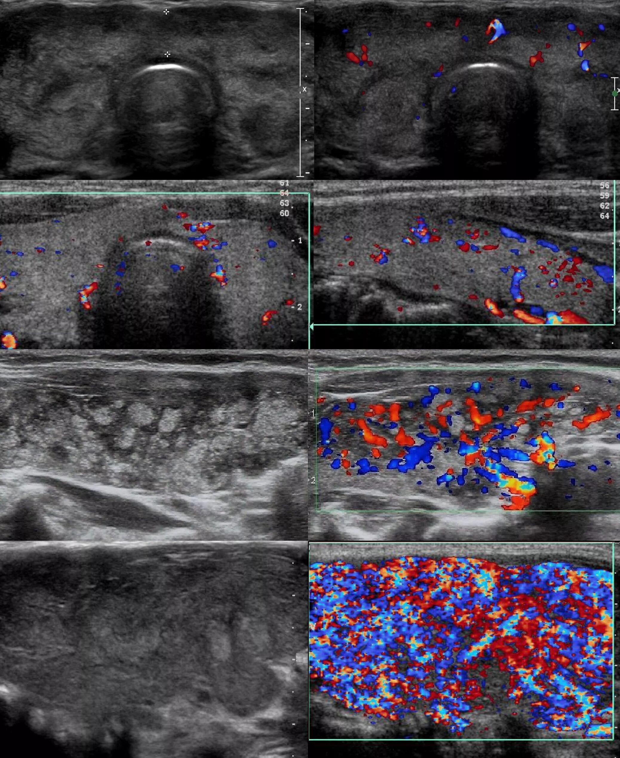 ЦДК гиперваскуляризация щитовидной железы. Кровоток щитовидной железы УЗИ. Сонограмма щитовидной железы. Цветное допплеровское картирование щитовидной железы. Можно ли перед узи щитовидной железы есть