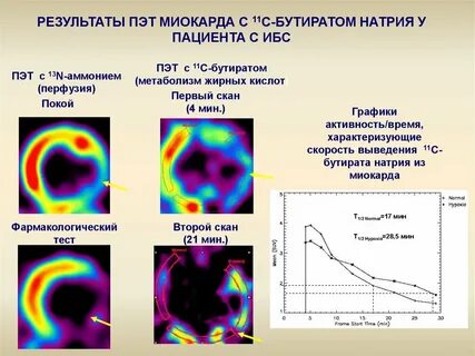 Результаты пэт