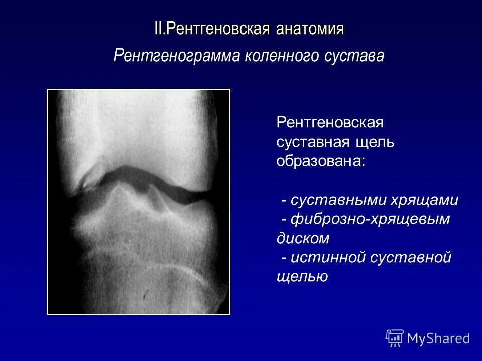 изменение высоты рентгеновской суставной щели схема. рентгенологическая суставная щель. норма рентгеновской суставной щели. анатомический субстрат рентгеновской суставной щели это. норма рентгеновской суставной щели коленного сустава.