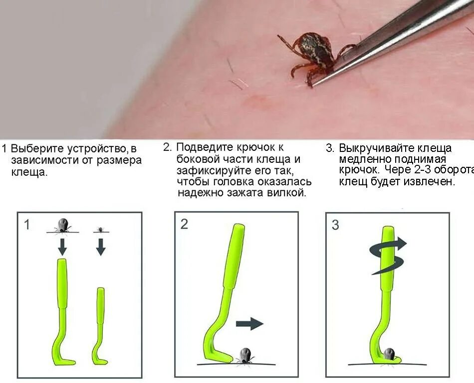 Как удалить клеща у человека самостоятельно присосавшегося. Специальный инструмент для извлечения клеща. Приспособление для извлечения клещей у людей. Устройство для вытаскивания клещей у людей. Извлекают клеща у человека.