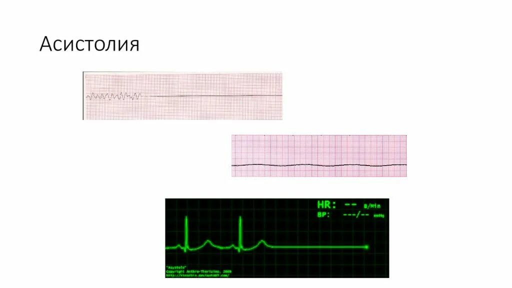 Асистолия сердца это. Асистолия на ЭКГ. Смерть на ЭКГ асистолия. Желудочковая асистолия. Сердце желудочковая асистолия.