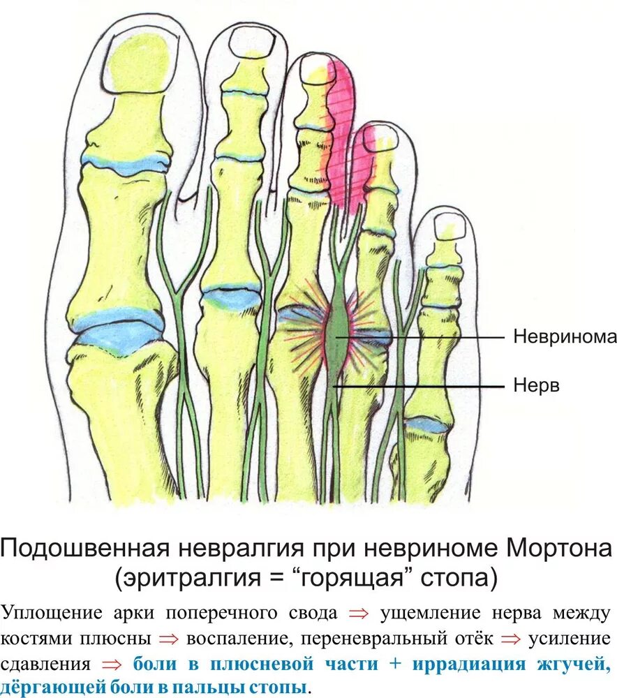Причины болят пальцы на ногах почему. Невринома Мортона стопы. Неврома Мортона операция. Болезни стопы неврома Мортона. Защемление нерва с Топе.