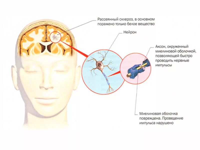 Склероз симптомы у мужчин на ранних стадиях. Рассеянный склероз и бульбарный синдром. Рассеянный склероз симптомы поражения пирамидных путей.. Поражения при рассеянном склерозе. Клинические проявления рассеянного склероза.