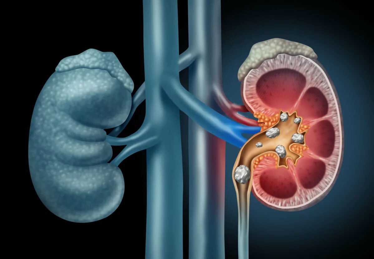 Мочекаменная болезнь камни в почках. Мочекаменная болезнь (urolithiasis). Мочекаменная болезнь (нефролитиаз). Заболевания мочевыделительной системы мочекаменная болезнь. Камень в почке 3 мм