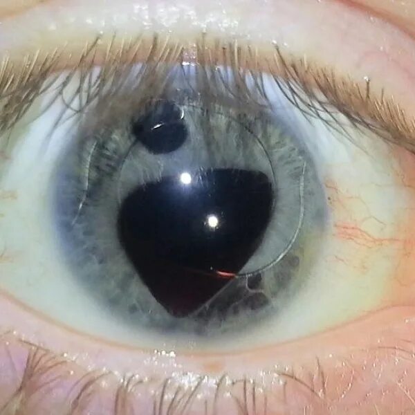 Нарост на глазном яблоке у человека фото Pterygium causes, treatments and surgery Clinica Sancho