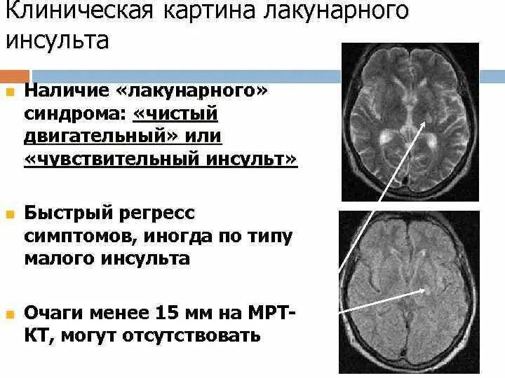 Очаг ишемии мозга. Лакунарный ишемический инсульт. Лакунарный ишемический инфаркт. Лакунарный ишемический инсульт мрт. Лакунарный инфаркт головного мозга кт.