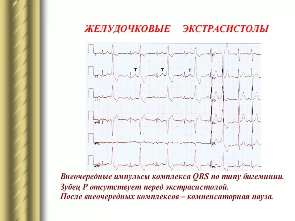 Желудочковая экстрасистолия бигеминия на ЭКГ. ЭКГ при желудочковой экстрасистолии по типу бигеминии. Желудочковая экстрасистолия по типу бигеминии. Желудочковая экстрасистолия по типу бигеминии на ЭКГ. Типы желудочковых экстрасистол