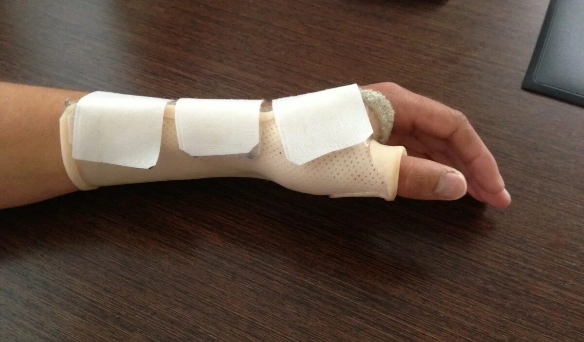 гипс на локтевой сустав. гипс при переломе 5 пястной кости. смещение руки в гипсе. гипс на локтевой сустав. гипс при переломе лучевой кости со смещением.