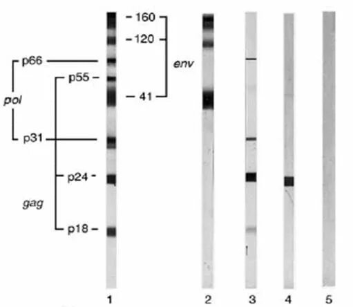Иммуноблот ВИЧ. Иммунный блоттинг ВИЧ инфекции. Иммуноблоттинг микробиология. Иммуноблот ВИЧ результат.