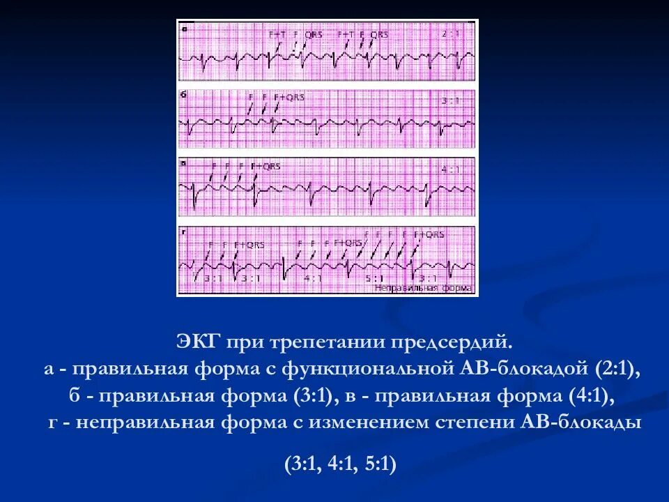 Трепетание предсердий 3 к 1 на ЭКГ. Трепетание предсердий 2 к 1 на ЭКГ. Трепетание предсердий 1 к 1 на ЭКГ. Правильная форма трепетания предсердий на ЭКГ. Формы трепетания предсердий