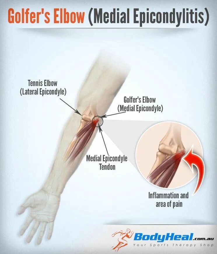 Почему болят локтевые сгибы. Локоть теннисиста латеральный эпикондилит. Медиальный надмыщелок локтевого сустава. Боковой эпикондилит локтевого сустава. Локоть гольфиста медиальный эпикондилит.