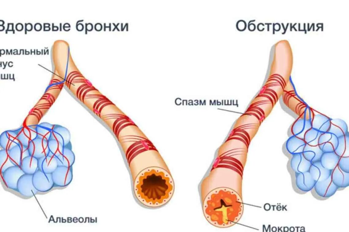 Ба про. Изменение бронхов при бронхиальной астме. Альвеолы при астме. Обструкция дыхательных путей бронхиальная астма. Обструкция дыхательных путей при бронхиальной астме.