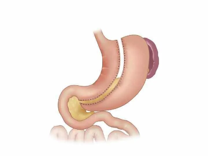 Продольная (рукавная) резекция желудка. Рукавная гастропластика желудка. Операция рукавная гастропластика. Вертикальная рукавная резекция желудка. Без желудка после операции