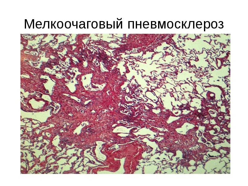 Диффузный пневмосклероз отзывы. Пневмосклероз патологическая анатомия. пневмосклероз гистология. пневмосклероз лёгких гистология. пневмосклероз. патологическая анатомия, исходы..