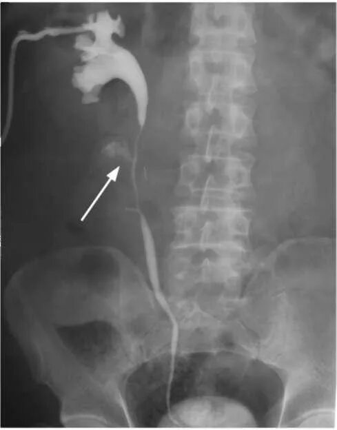 Рентген мочеточника. Экскреторная урография стриктура мочеточника. Обтурация мочеточника рентген. Ретроградная пиелография. Гидронефроз урография рентген.