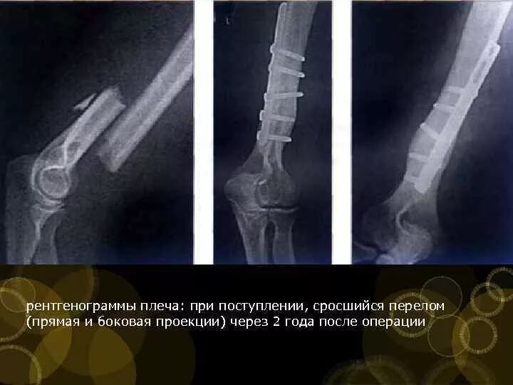 Сколько дней срастается перелом. Срастание плечевой кости после перелома. Сросшийся перелом на рентгене. Перелом плечевой кости сросся. Не срастается кость после перелома.