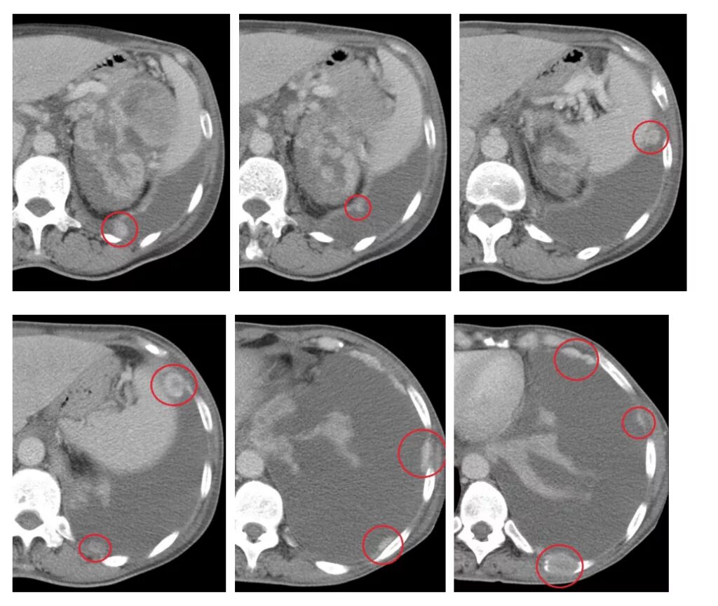 Метастатическое поражение плевры кт. Метастазирование опухоли почки.