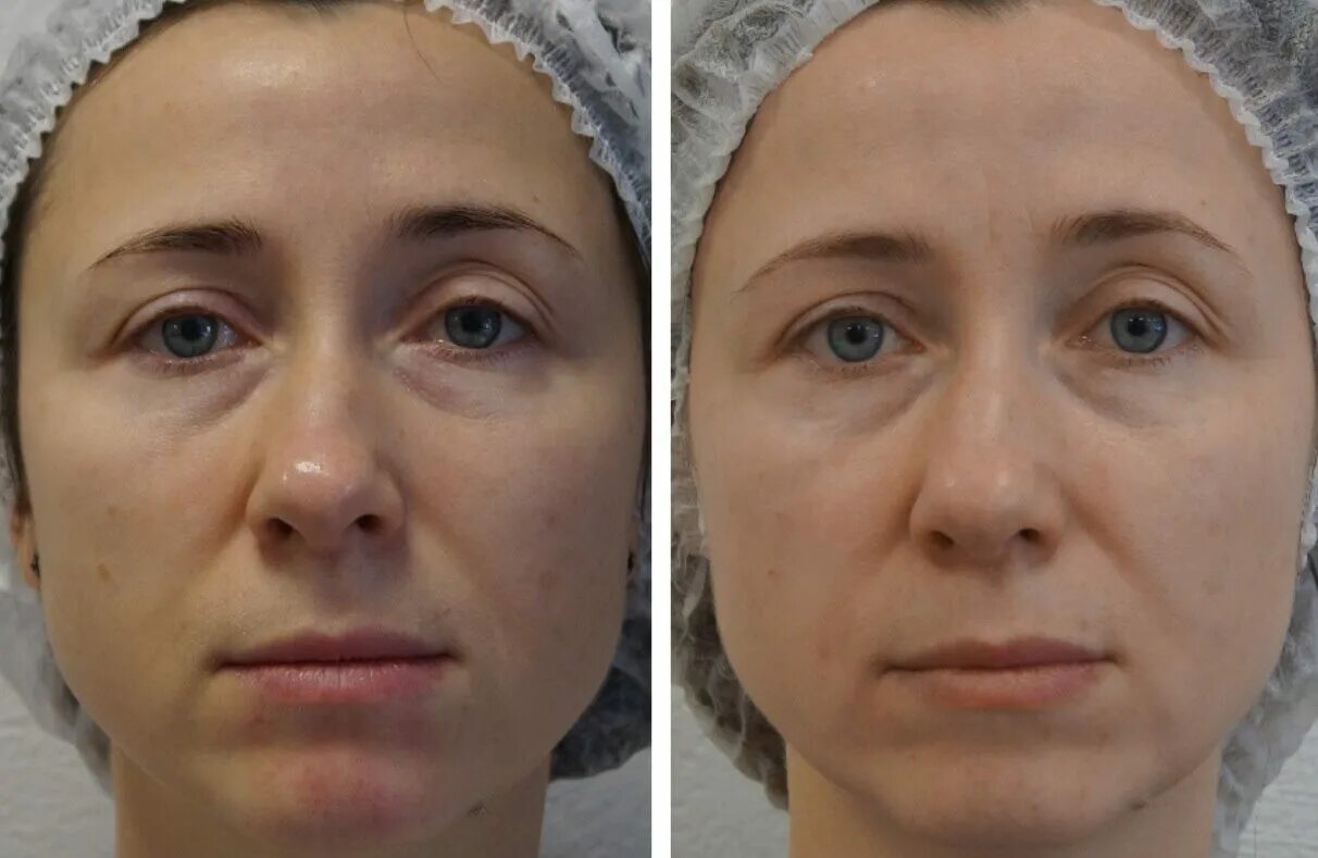 Микротоки лицо до и после фото отзывы. Микротоки для лица до и после. микротоки для лица lj b gjckt. микротоковая терапия до и после. микротоковая терапия лица эффект.