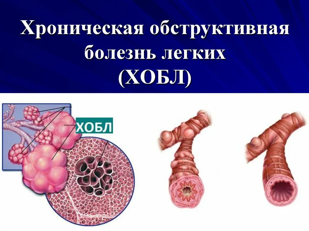 Бронхиальная болезнь легких. Обструктивная болезнь лёгких (ХОБЛ). Хроническая обструктивная болезнь легких.