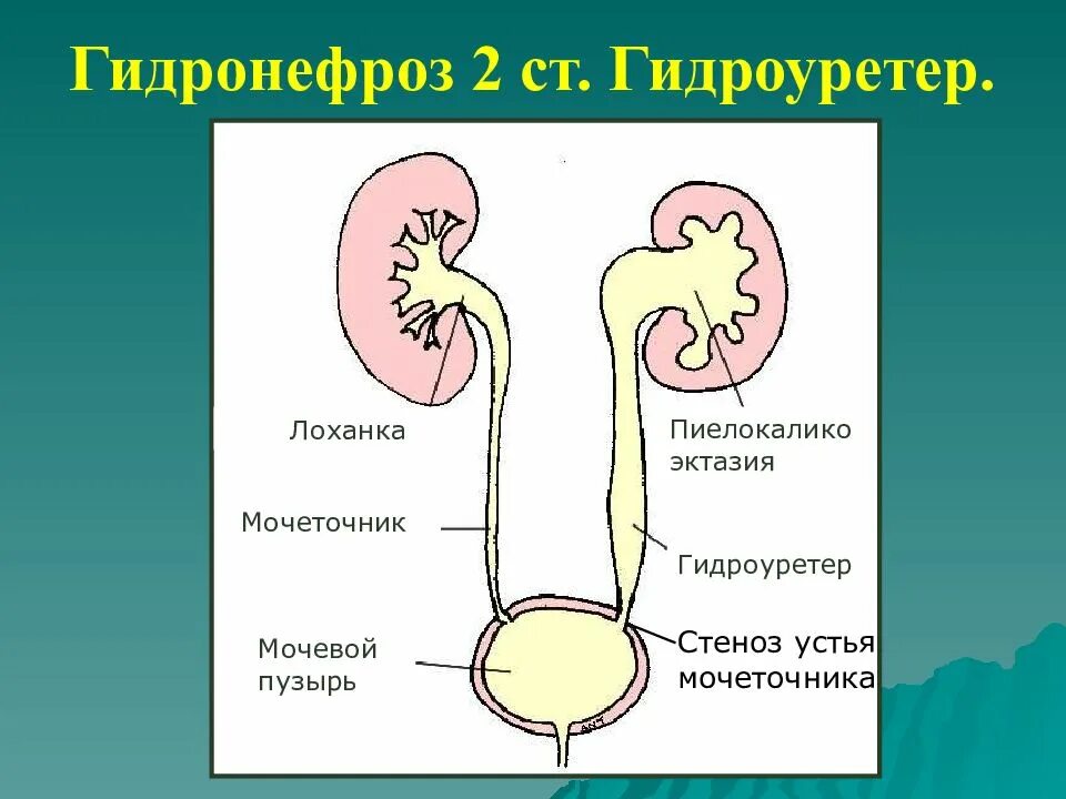 Показать мочеточник. Устье правого мочеточника. Устья левого мочеточника. Устье мочеточника почки.