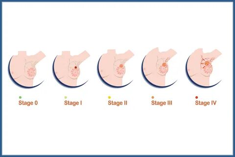 Stages of Breast Cancer - HealthyWomen 