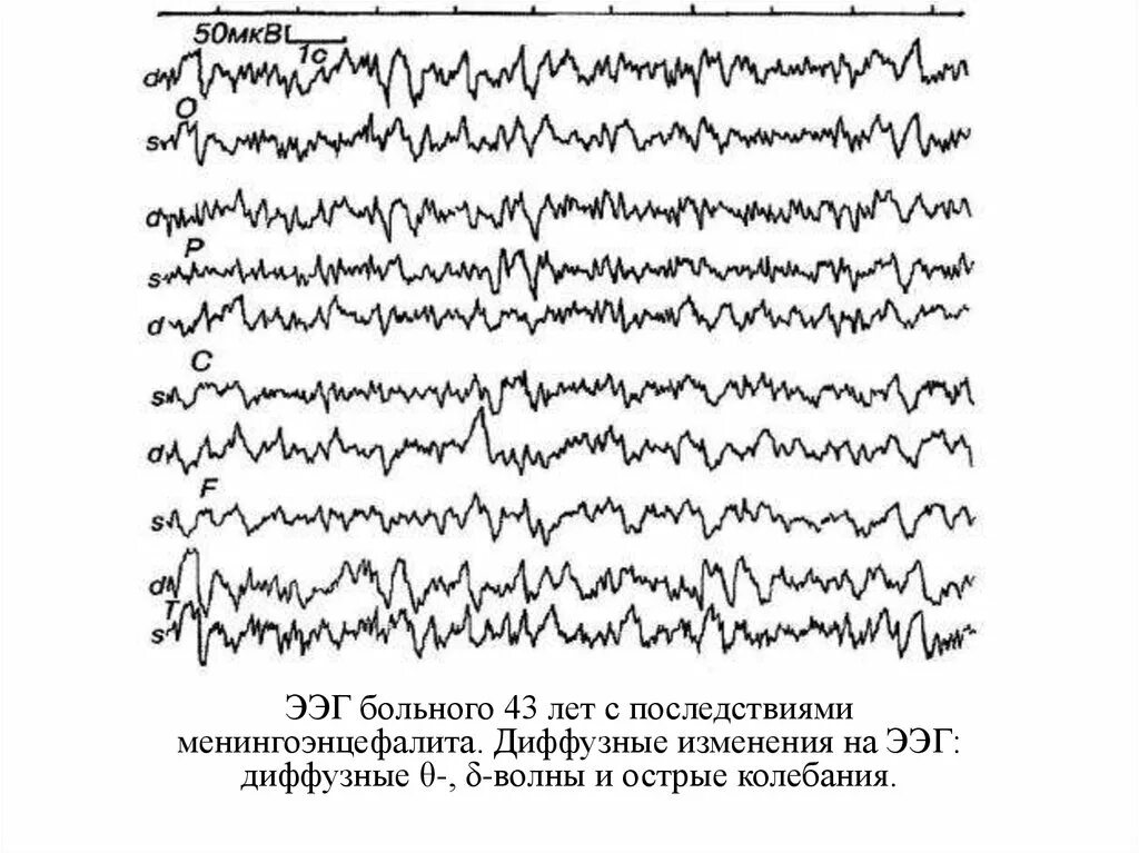 Заключения ЭЭГ С острыми волнами. Дистрофические изменения на ЭЭГ. Диффузные изменения на ЭЭГ. Диффузные изменения на ЭЭГ У ребенка. Диффузные волны