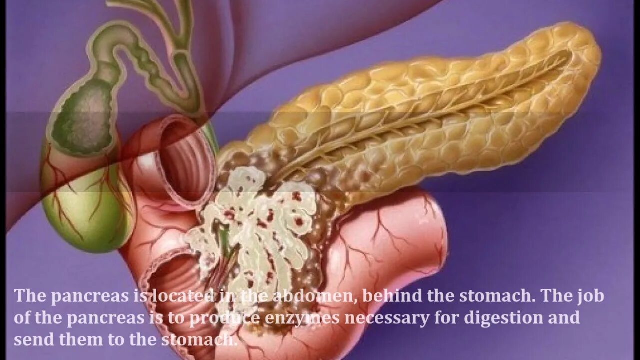 4 стадия поджелудочной железы сколько живут. Опухоль поджелудочной. Поджелудочная железа человека. Аденокарцинома поджелудочной железы.