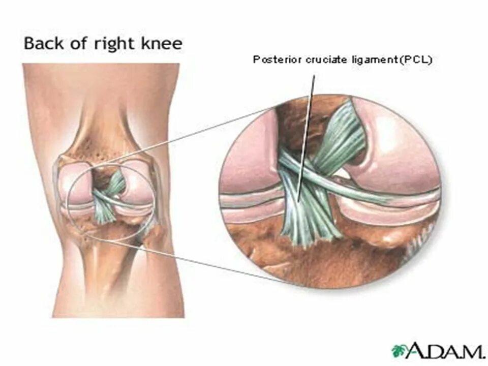Крестовидная коленная связка. Крестообразная связка коленного сустава. Пластика передней крестообразной связки. Крестовидная связка колена. Операция на крестообразной связки коленного сустава.