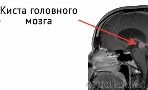 Чем опасна киста в мозгу. Лакунарная киста головного мозга на кт. Киста головного мозга на кт. Киста головного мозга справа. Киста головного мозга симптомы.