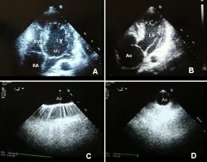 Пролапс митрального клапана УЗИ. Пролапс митрального клапана на Эхо. Створки митрального клапана на УЗИ.