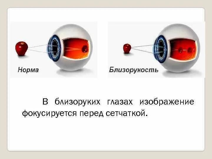 У близоруких людей изображение фокусируется перед сетчаткой. Близорукость перед сетчаткой. Изображение фокусируется перед сет. Изображение в близоруком глазу фокусируется. Изображение фокусируется перед сетчаткой.