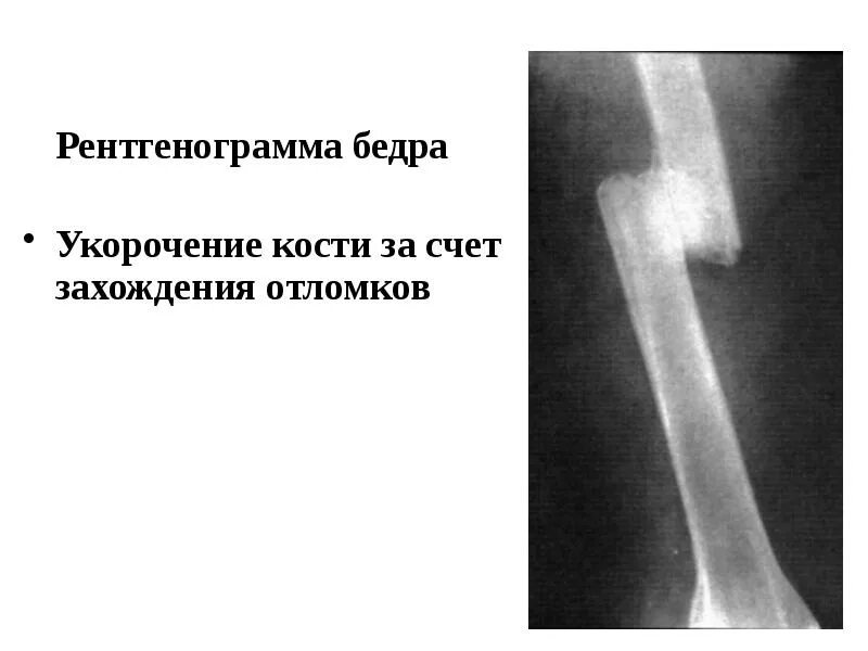 Отломок кости это что. Перелом бедренной кости с расхождением отломков. Винтообразный перелом голени. Классификация переломов трубчатых костей. Винтообразный перелом диафиза бедренной кости.