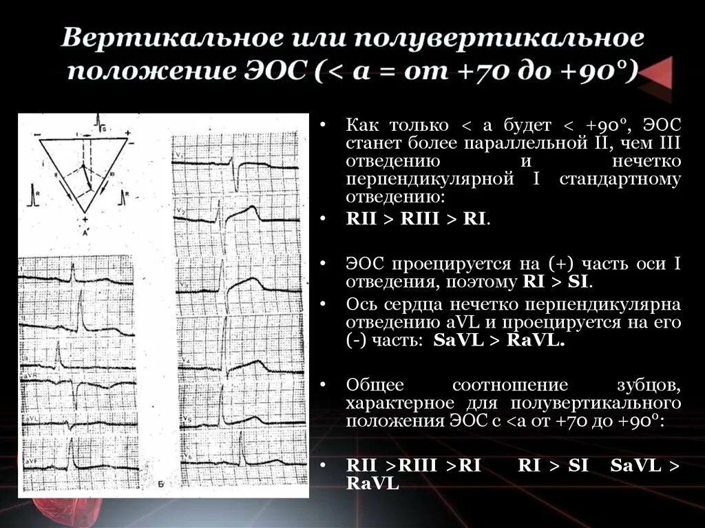 Вертикальная позиция сердца. Вертикальное положение ЭОС на ЭКГ. Вертикальное направление ЭОС на ЭКГ У ребенка. Вертикальная электрическая ось сердца на ЭКГ. Отклонение ЭОС вертикальное на ЭКГ что это.