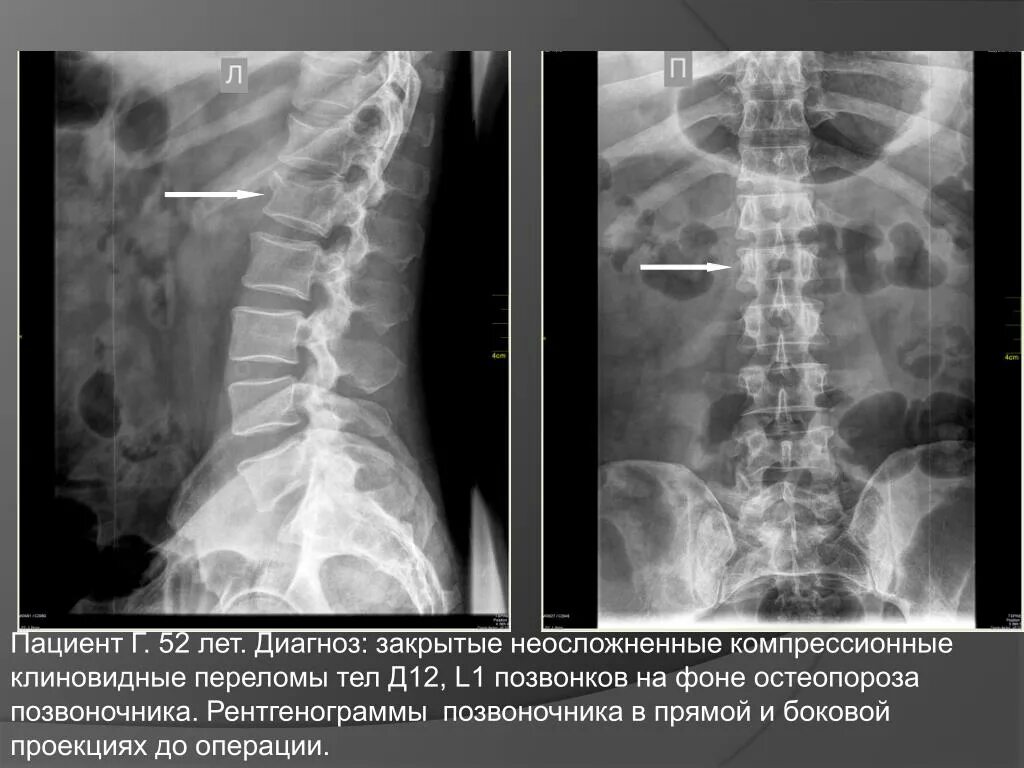 Рентгенография позвоночника в 2 х проекциях. Что такое компрессионный перелом позвонка клиновидный l 1. Компрессионный перелом позвоночника l12. Компрессионный перелом позвоночника остеопороз рентген. Клиновидный компрессионный перелом позвоночника l1.