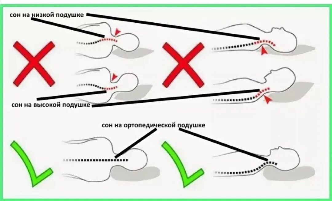 Остеохондроз спать без подушки. Правильное положение головы при сне. Правильное положение головы во время сна на подушке. Правильные положения для сна с подушкой. Правильное положение для сна при шейном остеохондрозе.