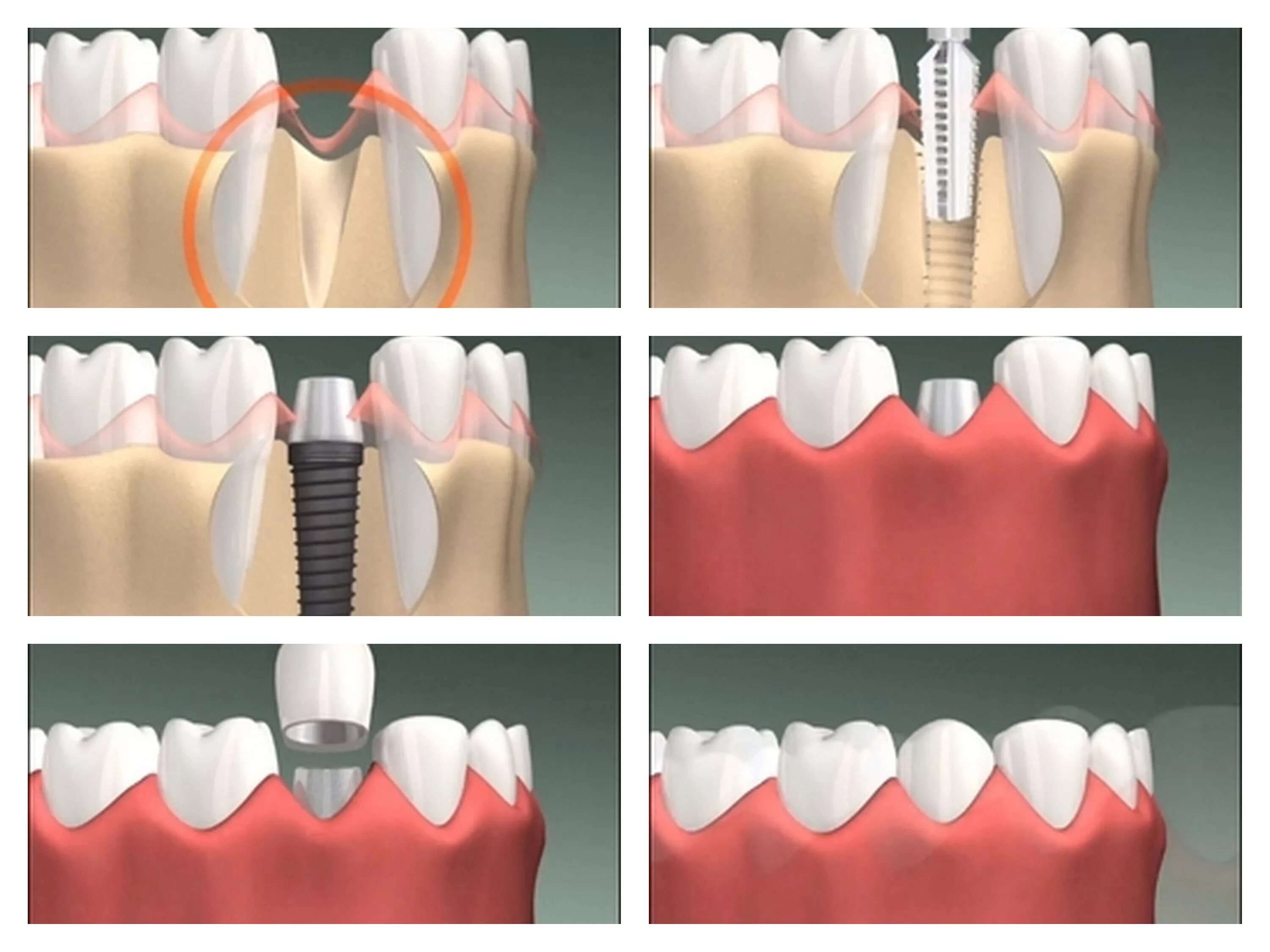Зубы импланты поэтапно