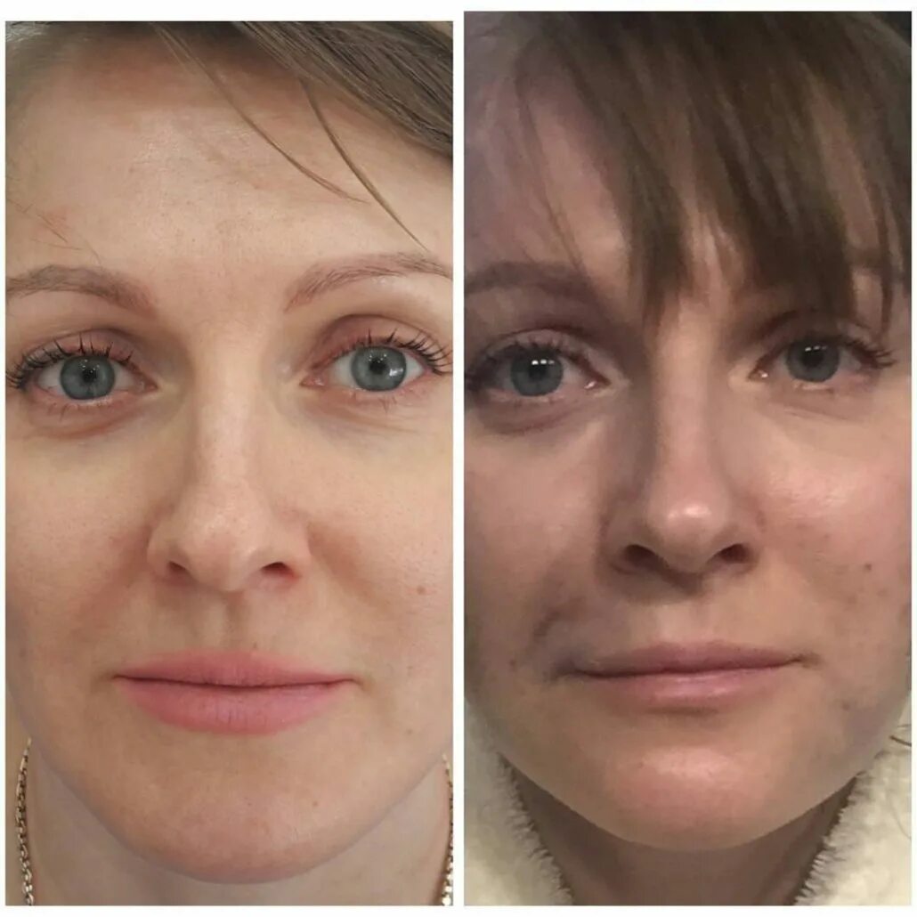биоревитализация лица до и после.