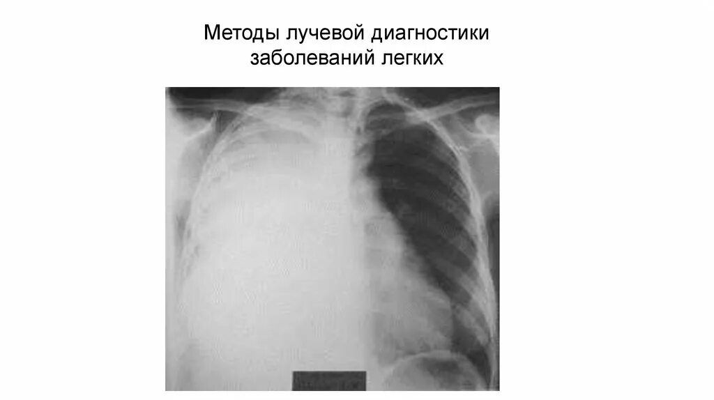 Актуальные вопросы лучевой диагностики заболеваний легких. Хронические воспалительные заболевания. Лучевая диагностика неотложных состояний. Актуальные вопросы лучевой диагностики заболеваний легких. Актуальные вопросы лучевой диагностики заболеваний легких.