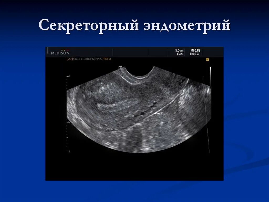 УЗИ ранняя секреторная фаза. Секреторный эндометрий. Секреторный Тип эндометрия. Секреторный эндометрий по УЗИ. Железо и эндометрий