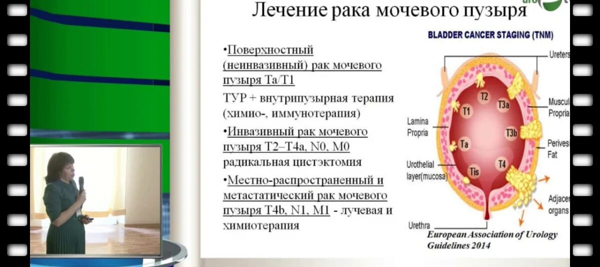 Удаление мочевого пузыря при раке. Лечение паха мочевого пузыря. Принципы комбинированного лечения новообразований мочевого пузыря. Размер опухоли мочевого пузыря по стадиям. Раковая опухоль мочевого пузыря.