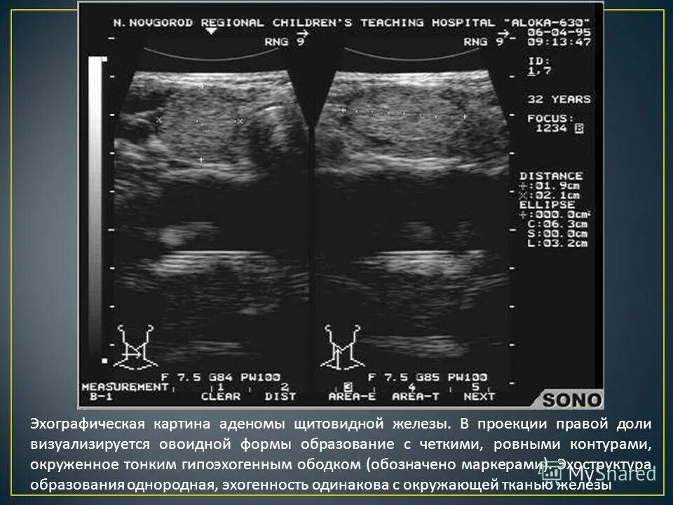 анэхогенная структура узи.