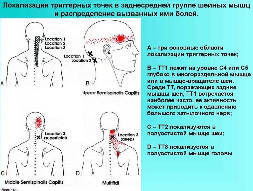 Болит шея у основания головы. Мышцы шеи триггерные точки схема. Триггерные точки шейного отдела.