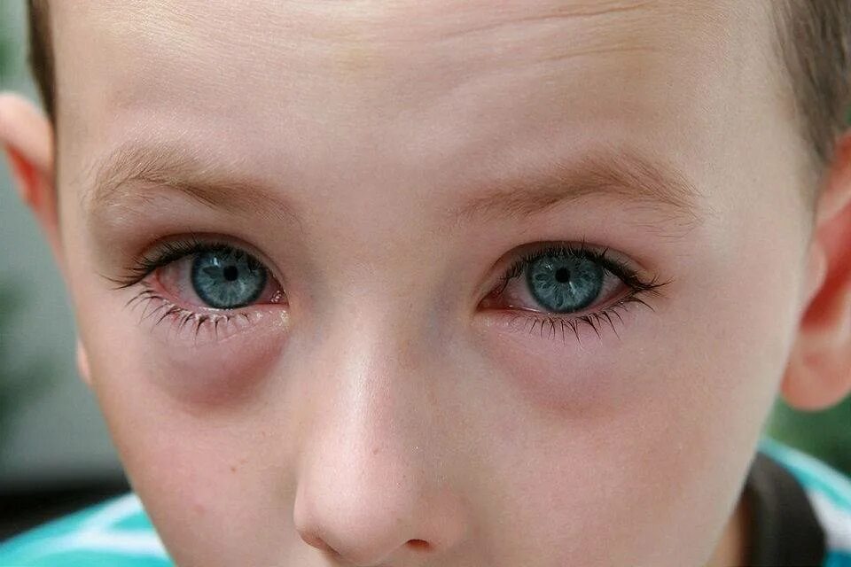 Детская глазная болезнь. Припухлость под глазами у ребенка. У ребенка конъюнктивит и опухло под глазом.