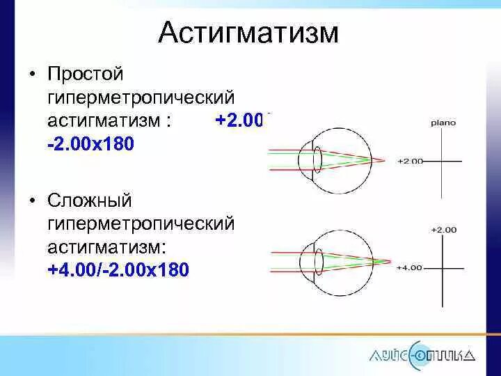 Гиперметропический астигматизм 2. Астигматизм миопический простой обратный. Сложный гиперметропический астигматизм прямого типа. Гиперметропия сложной степени астигматизм. Сложный гиперметропический астигматизм глаз