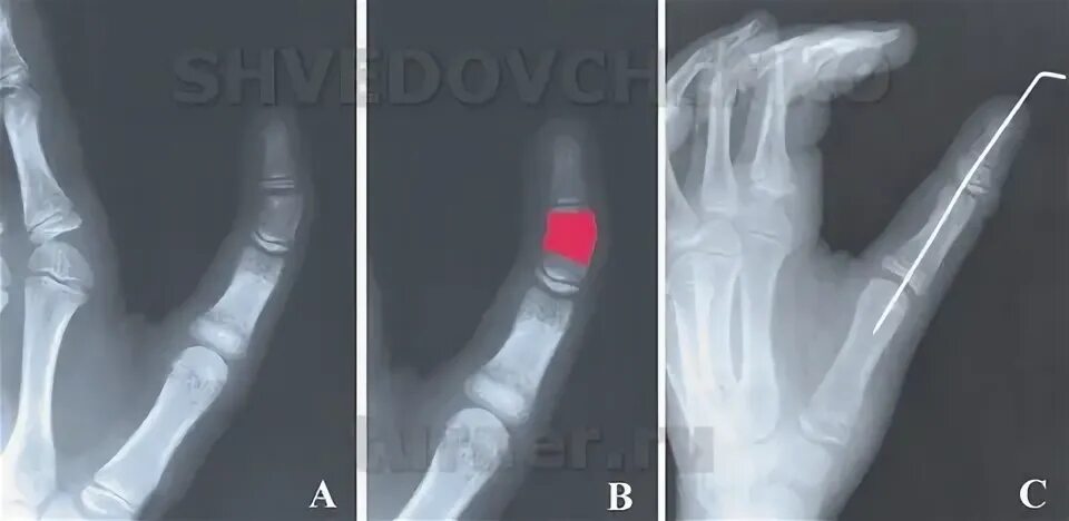 перелом ногтевой фаланги мкб 10