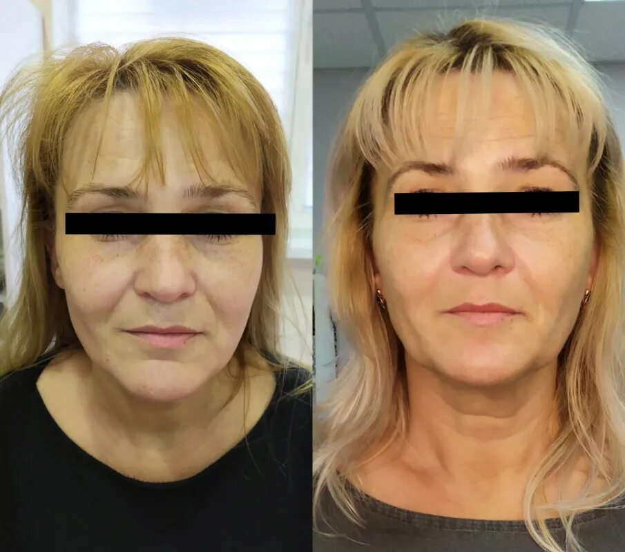 Smas лифтинг цена skinlift ru. Смас лифтинг Альтера. Смас лифтинг носогубка. ХИФУ лифтинг.