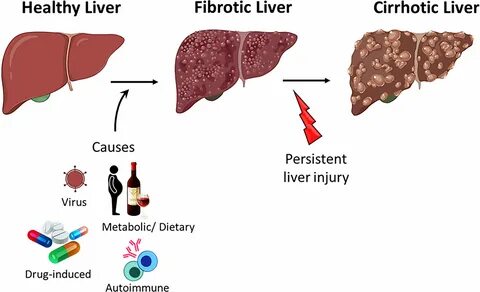 Расширенная шкала фиброза печени enhanced liver fibrosis elf - фото презент...